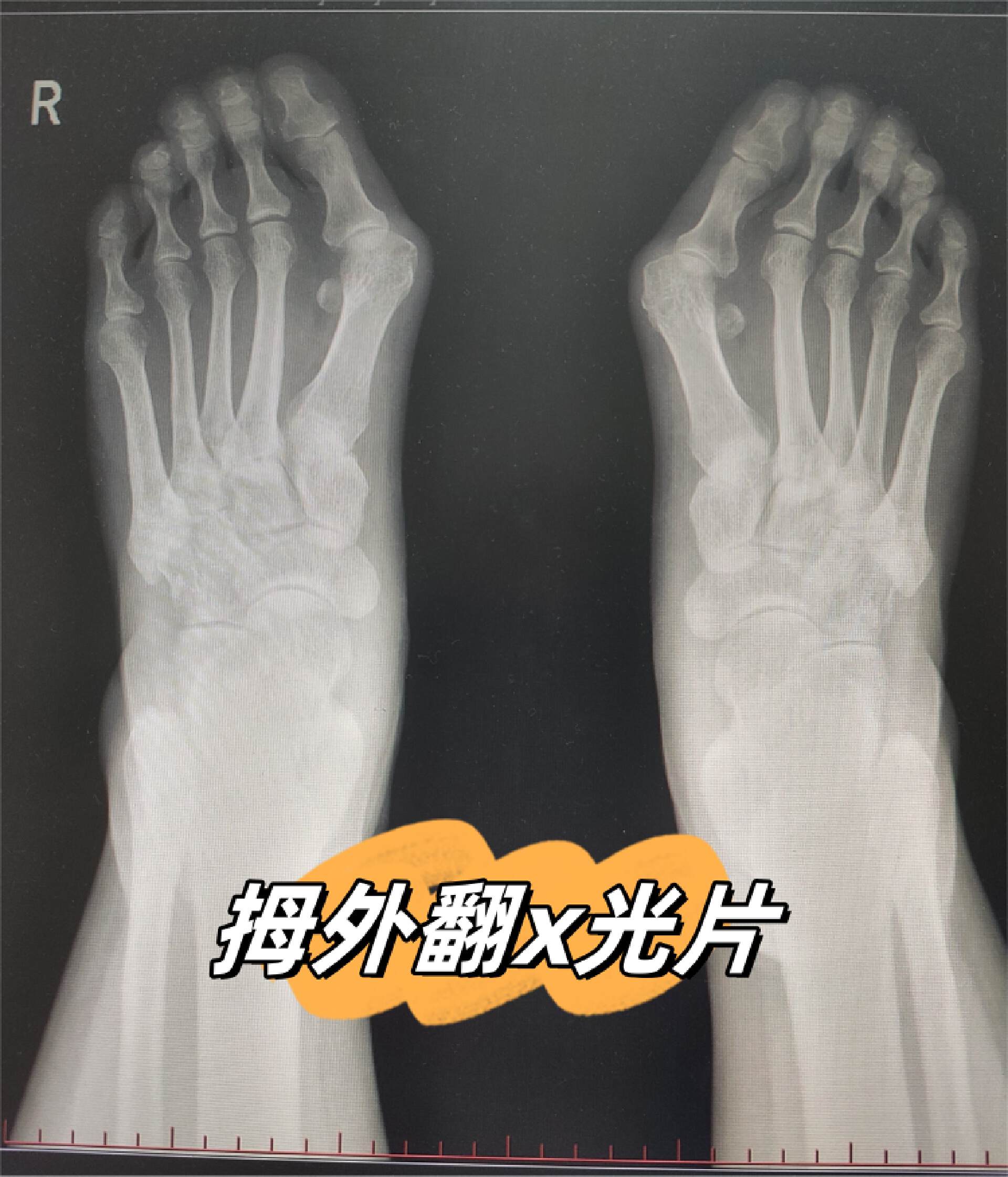 JJJ正式接受脚趾手术三个月后重新评估